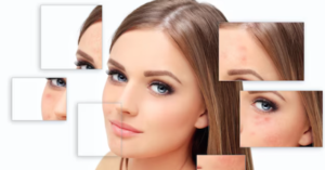 How to Prevent Acne Naturally in 2026