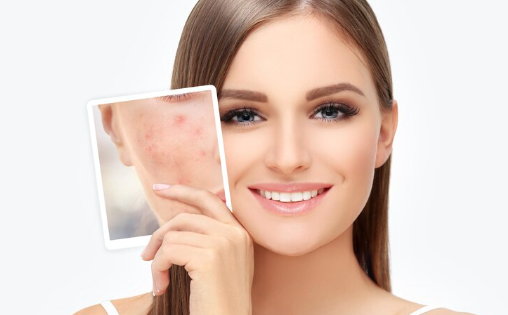 Preventing acne naturally in 2026